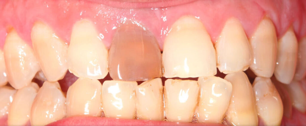 Η Λεύκανση Μαύρου Δοντιού είναι μια διαδικασία λεύκανσης δοντιών που γίνεται εσωτερικά του δοντιού. Κανονικά γίνεται σε ένα δόντι που έχει υποστεί προηγουμένως απονεύρωση .  Ο κυριότερος λόγος ο οποίος γίνεται αυτό είναι επειδή ένα νεκρό δόντι χάνει την  ζωτικότητα του και αφυδατώνεται, με αποτέλεσμα να μαυρίζει. Ένας 2ος λόγος είναι χάλασμα του δοντιού από τερηδόνα. Στην πρώτη περίπτωση, η εσωτερική λεύκανση είναι η μόνη επιλογή. Βασικά, η εσωτερική λεύκανση είναι μια διαδικασία που στοχεύει τον αποχρωματισμό από μέσα προς τα έξω. Με αυτόν τον τρόπο μπορείτε να βεβαιωθείτε ότι τα δόντια σας θα είναι και πάλι λευκά!